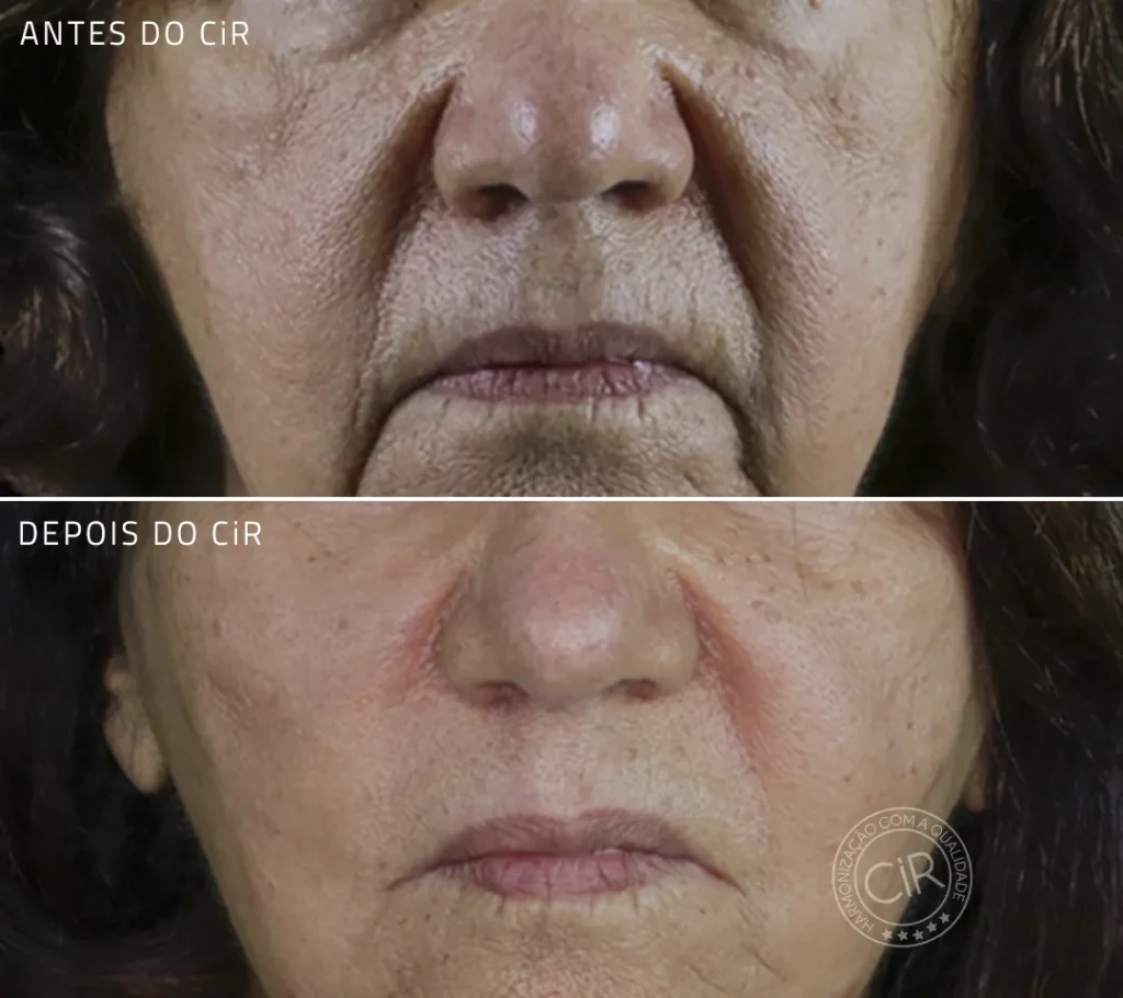 ante e depois do tratamento de bigode chinês em paciente de 78 anos no cir harmonização facial atendemos brasília lago sul lago norte asa sul asa norte