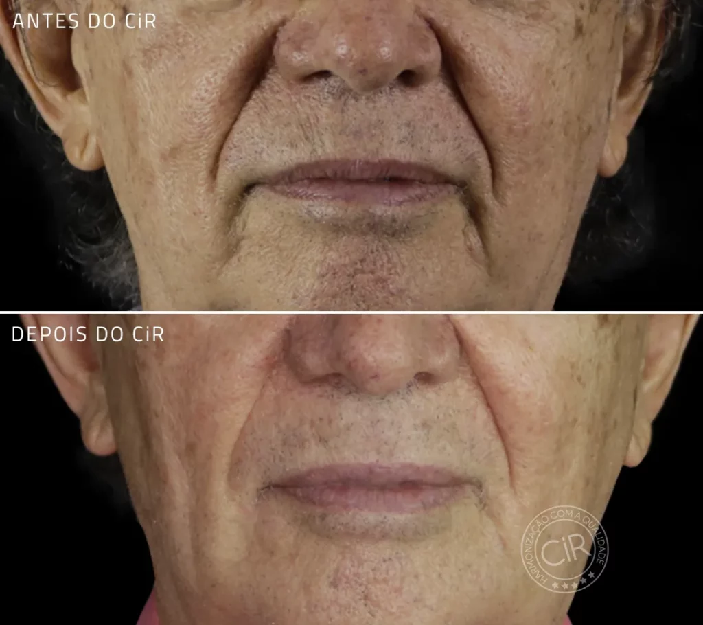 ante e depois do tratamento de bigode chinês em paciente de 73 anos no cir harmonização facial atendemos brasília lago sul lago norte asa sul asa norte