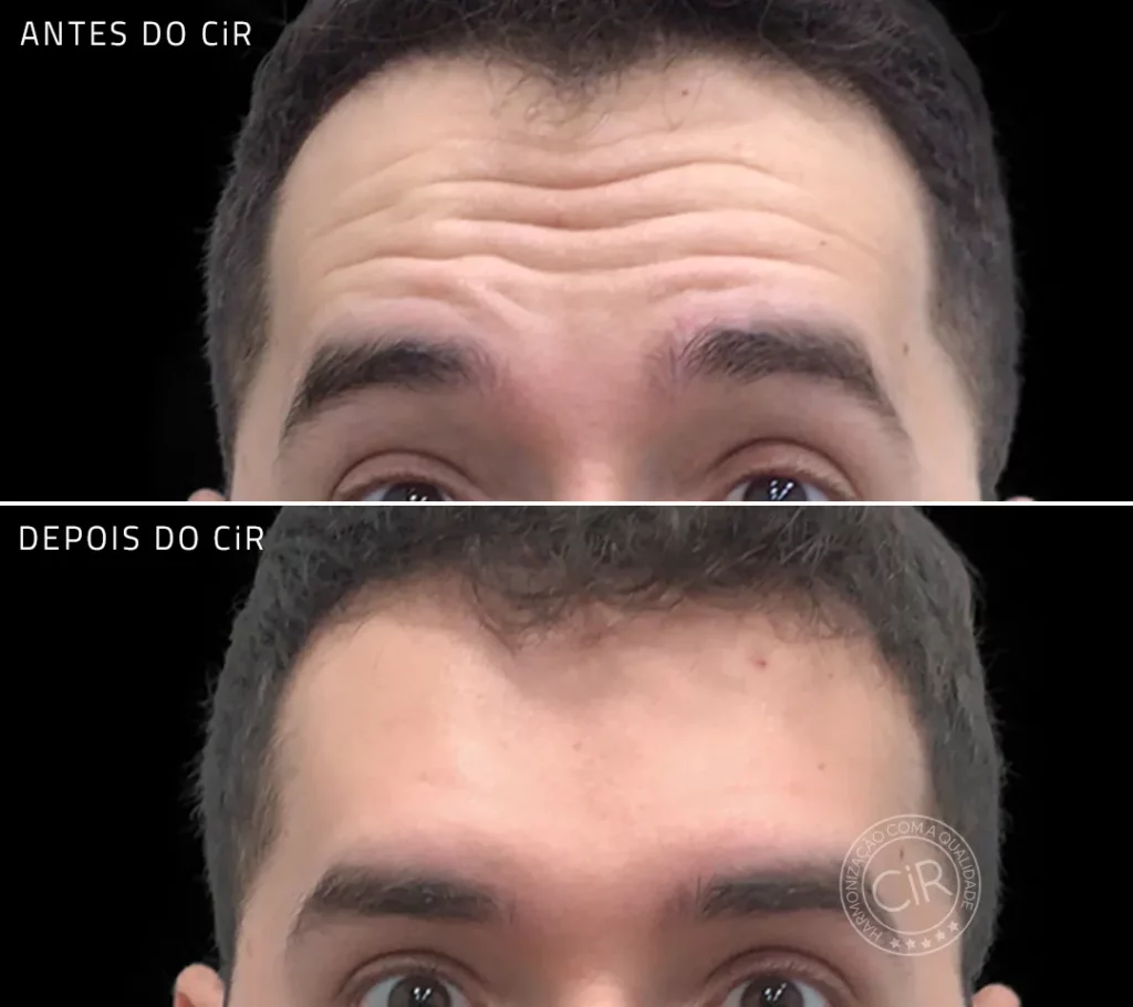 antes e depois do tratamento de botox em paciente masculino de 28 anos no cir harmonização facial atendemos lago sul lago norte asa sul asa norte noroeste sudoeste park way