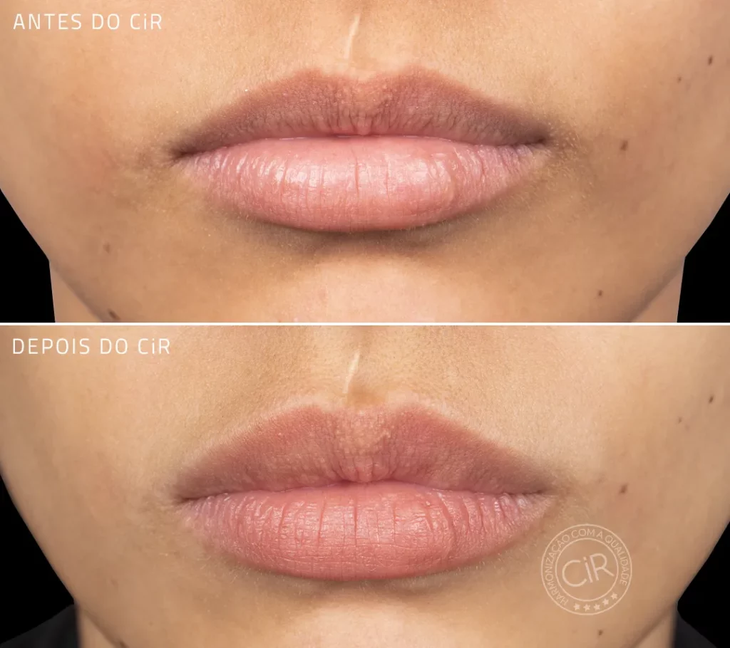 antes e depois do preenchimento labial realizado aqui no cir harmonização facial atendemos lago sul lago norte asa sul asa norte